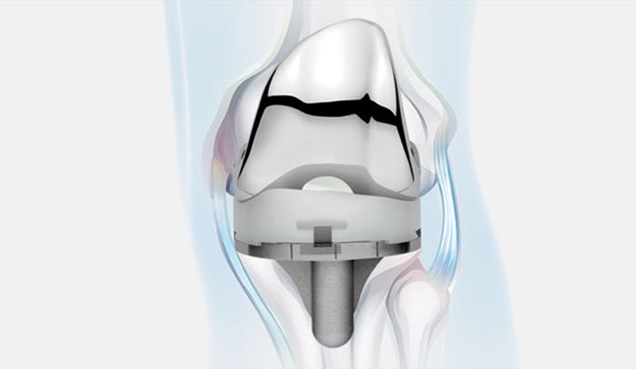 Evolution Medial-Pivot Knee