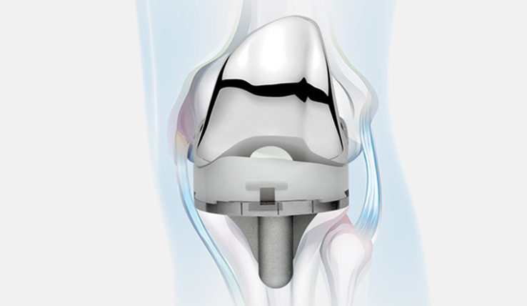 Evolution Medial-Pivot Knee System implant