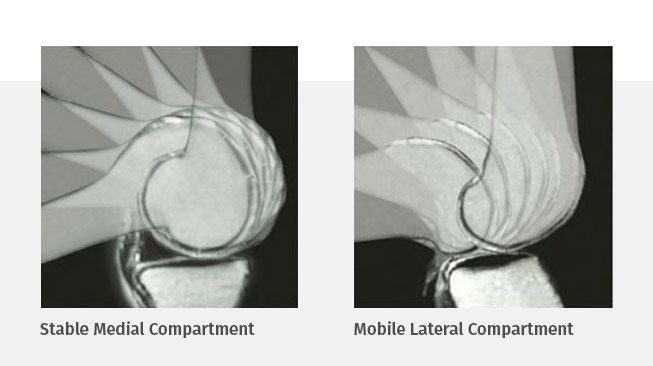 Medial-pivot articulation compared with a traditional knee design