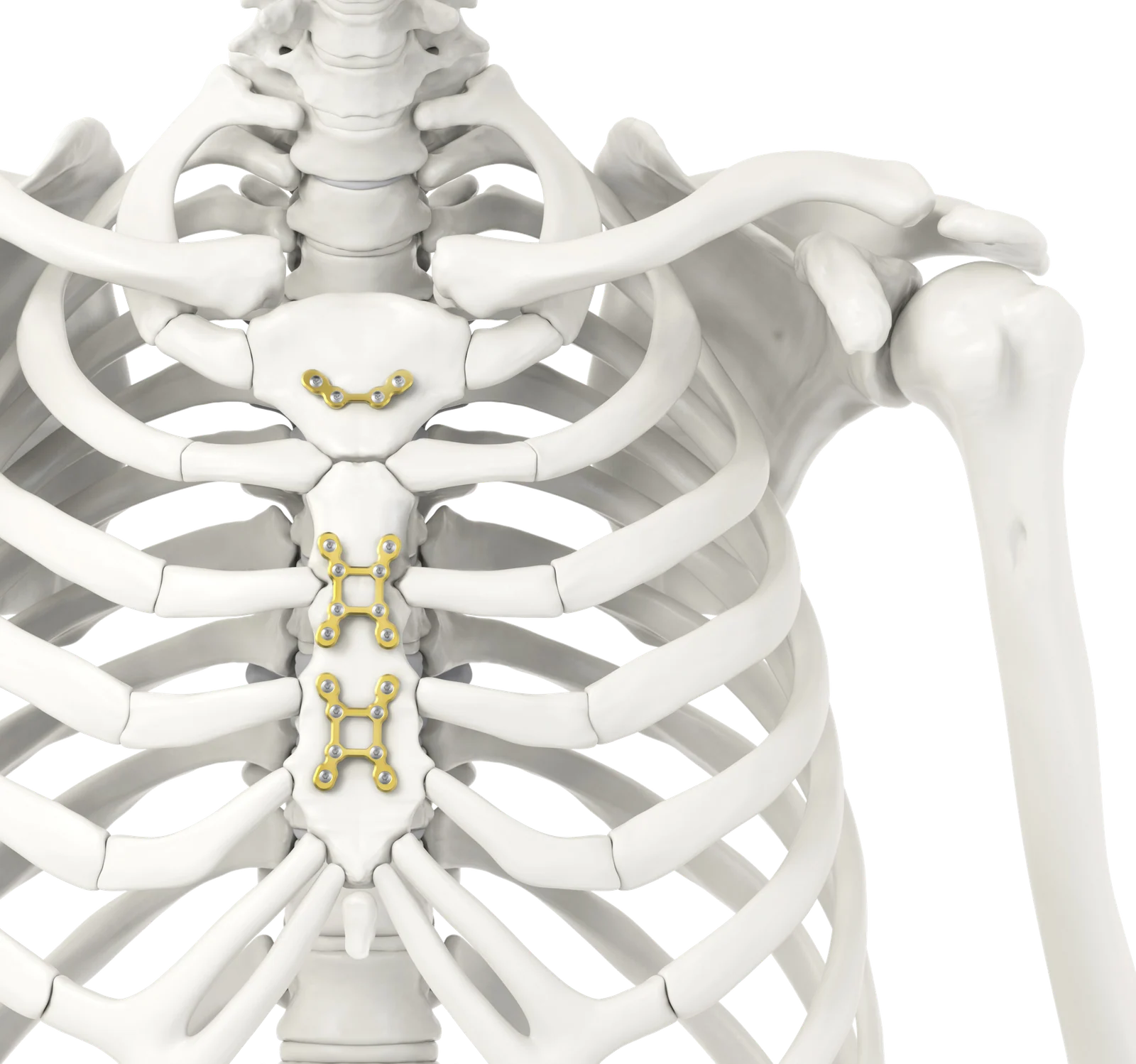 Sternal plates fixed on the manubrium and the sternal body