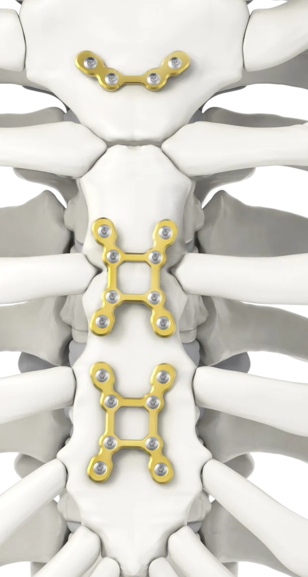 An L plate on the manubrium and two X plates on the sternal body